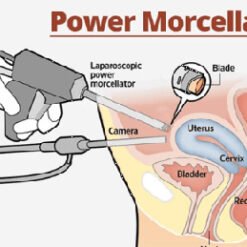 Hysteroscopic-Morcellator-for-Removal-of-Intrauterine-Polyps